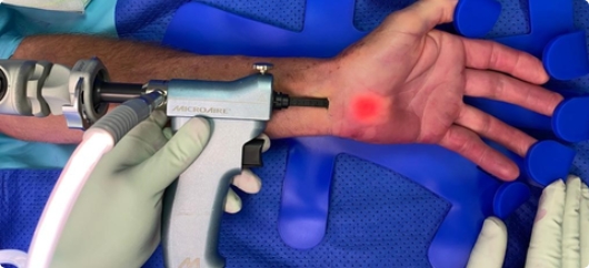 Care First Orthopaedic - Endoscopic Carpal Tunnel Release